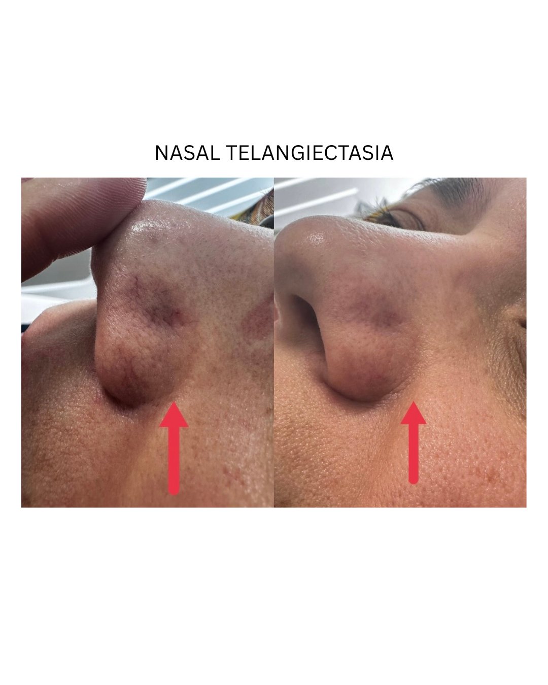 DK NASAL_Vein treatment